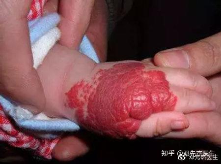 血管瘤对宝宝危害有多大可不仅仅是长了个红胎记那么简单