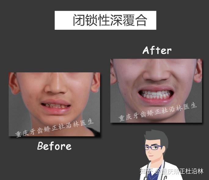 重庆牙齿矫正杜沿林重度闭锁性深覆合案例