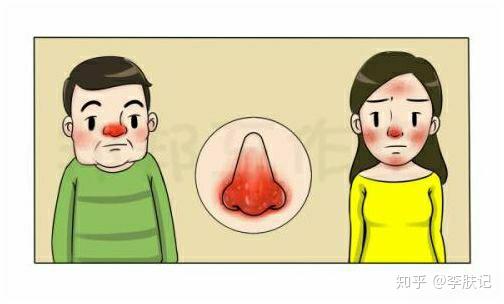 面部皮炎诊疗指南 - 知乎