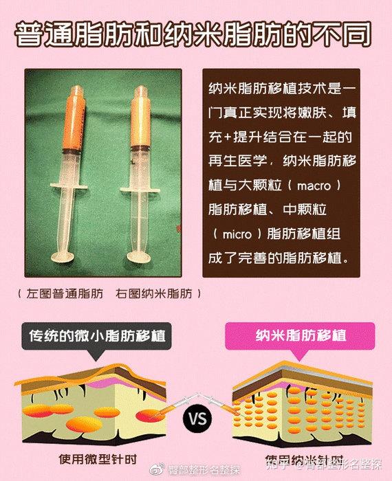 大颗粒脂肪，小颗粒脂肪，纳米脂肪和svf脂肪胶的区别 - 知乎