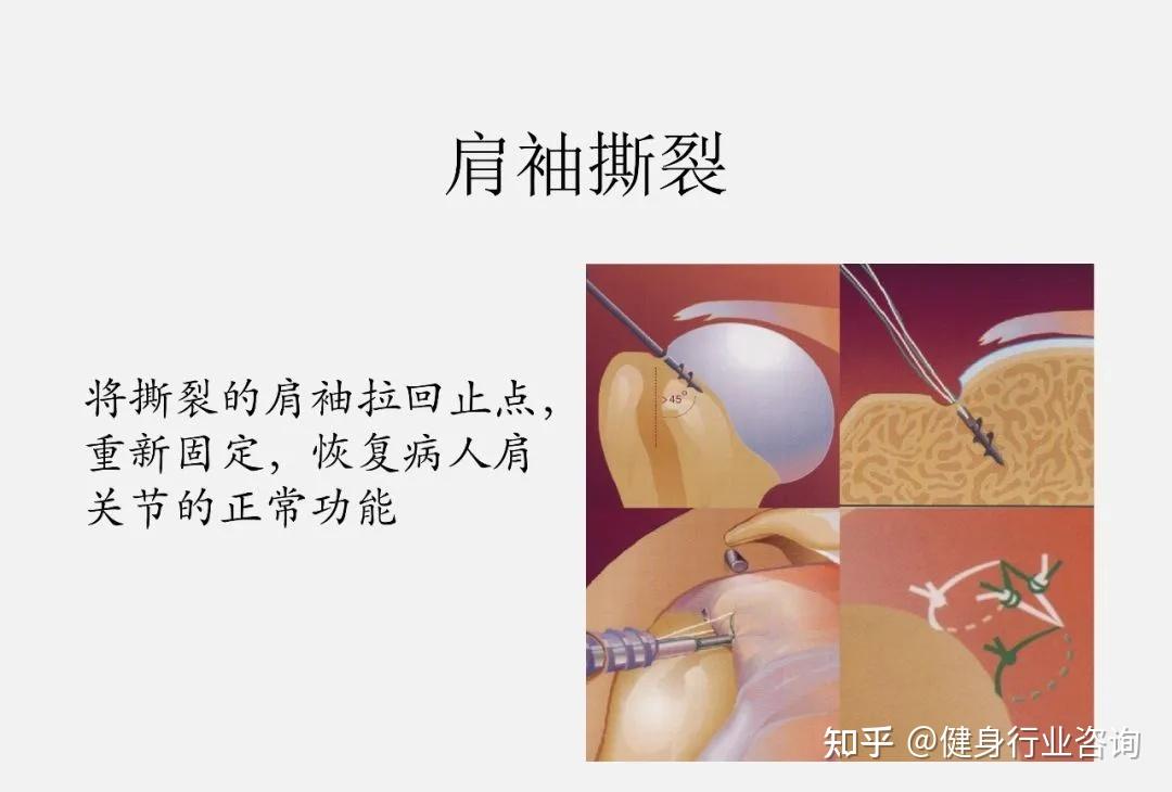 肩袖损伤怎么治疗最佳图片