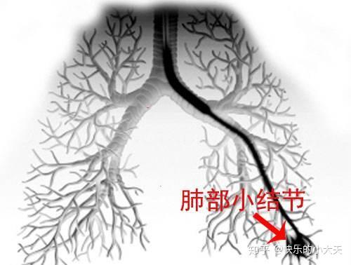 什么样的肺结节是肺癌 6类人要小心 发现结节这样做才安心 知乎 什么样的肺结节是肺癌 6类人要小心 发现结节这样做才安心 知乎