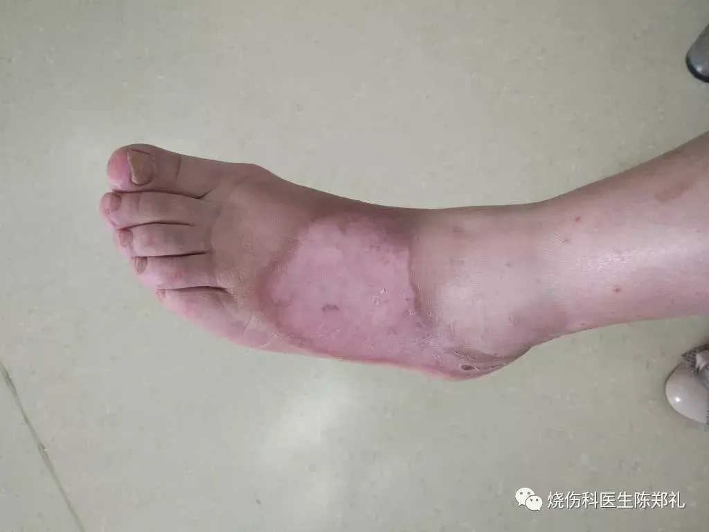 创面没长好之前究竟能否碰水 知乎