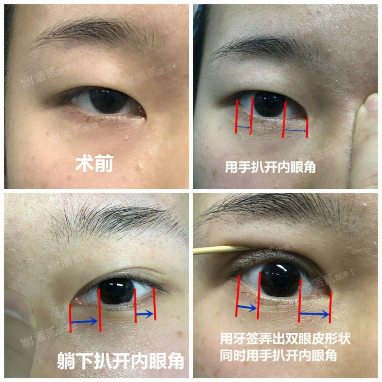 开内眼角内眦赘皮矫正术成功了眼睛看起反而丑了还更奇怪