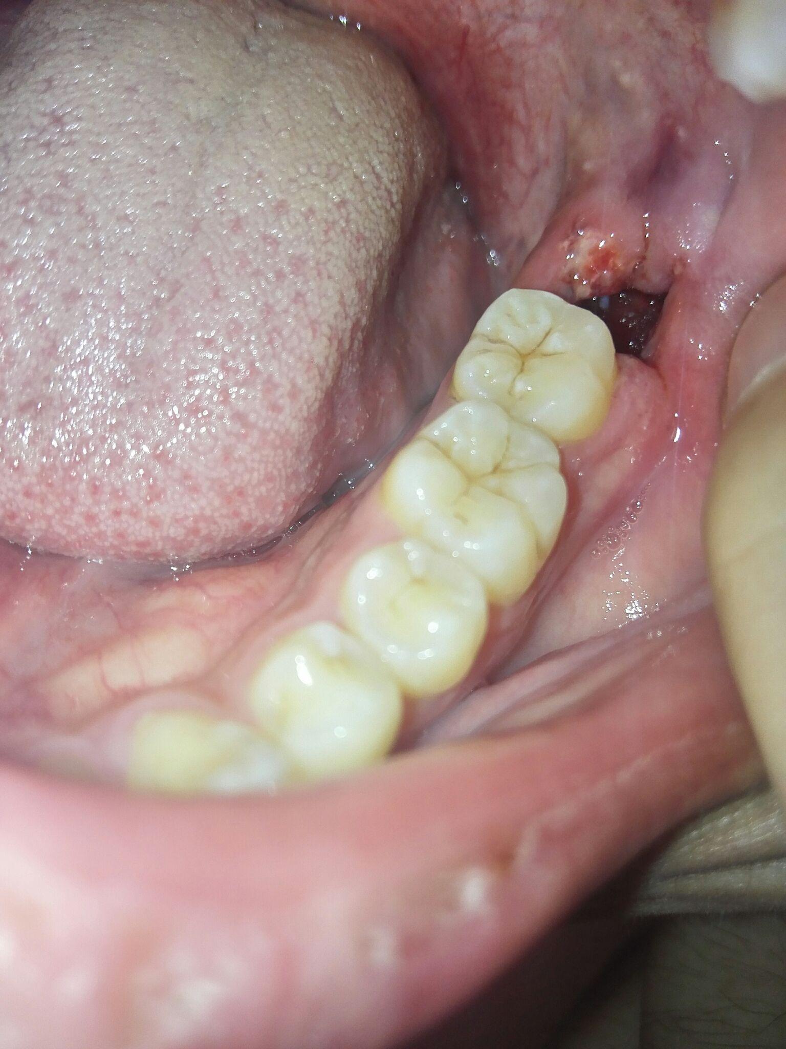 比较严重的牙周炎(时不时会流牙血)应该如何治疗？ - 知乎