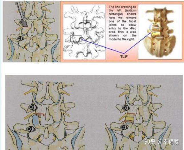 plfpliftlif dlif xlif 手术技术对比