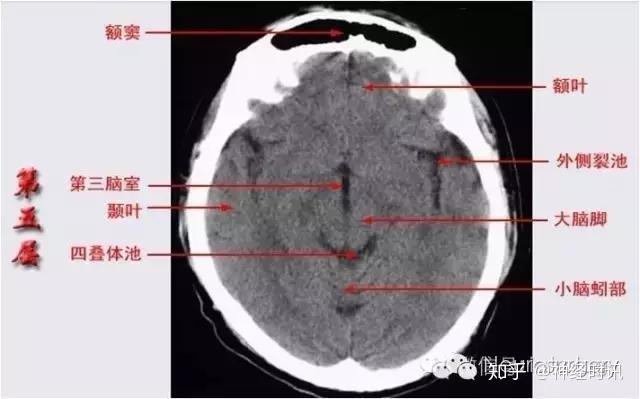 解剖&影像 —— 颅脑ct解剖口诀及彩色解剖图