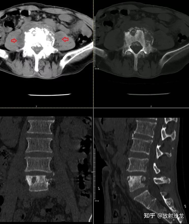 椎体终板炎 | 发生机制、分型以及 MRI 表现 - 知乎