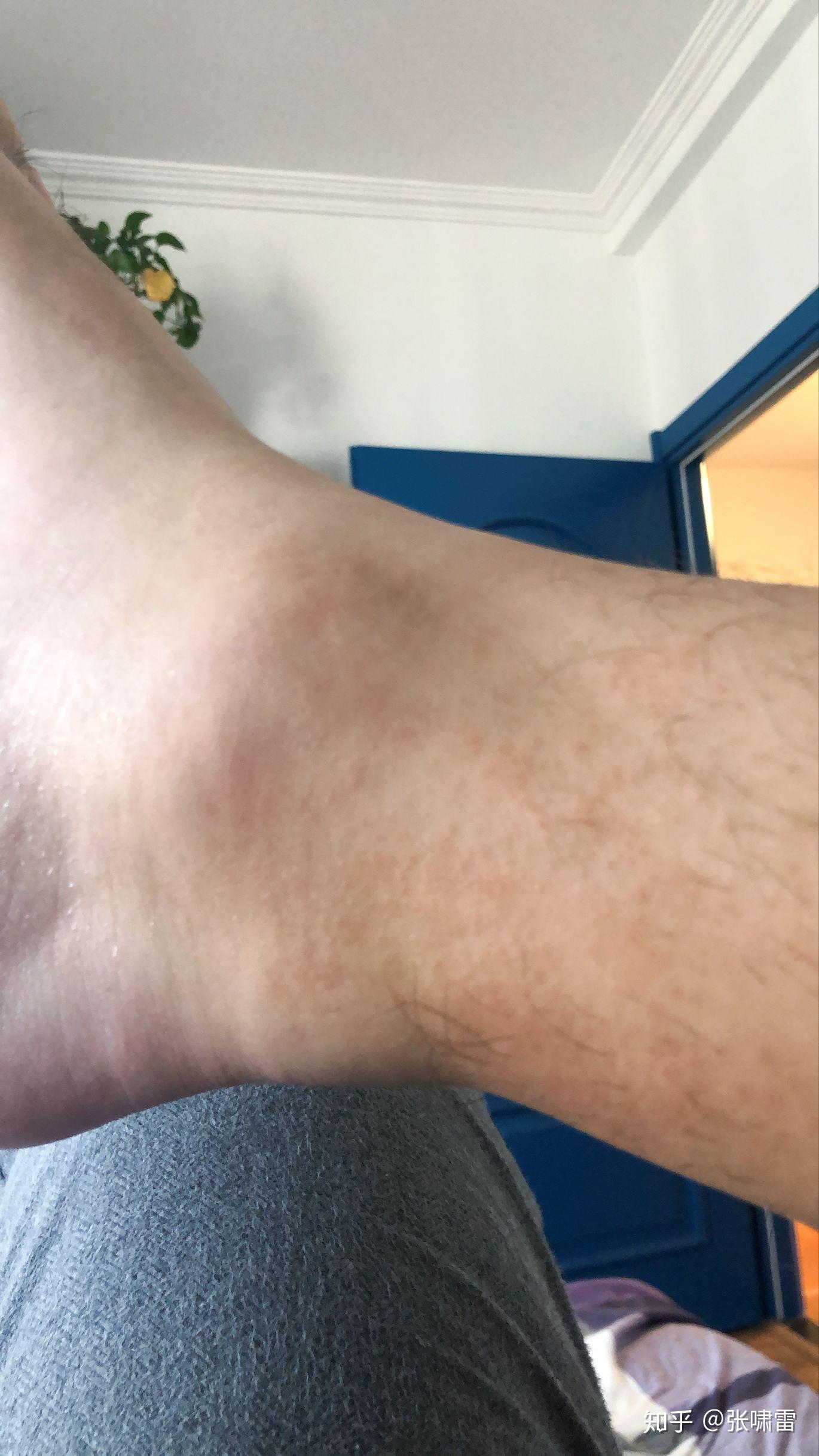 记保守治疗下跟腱断裂的全过程,含二断过程