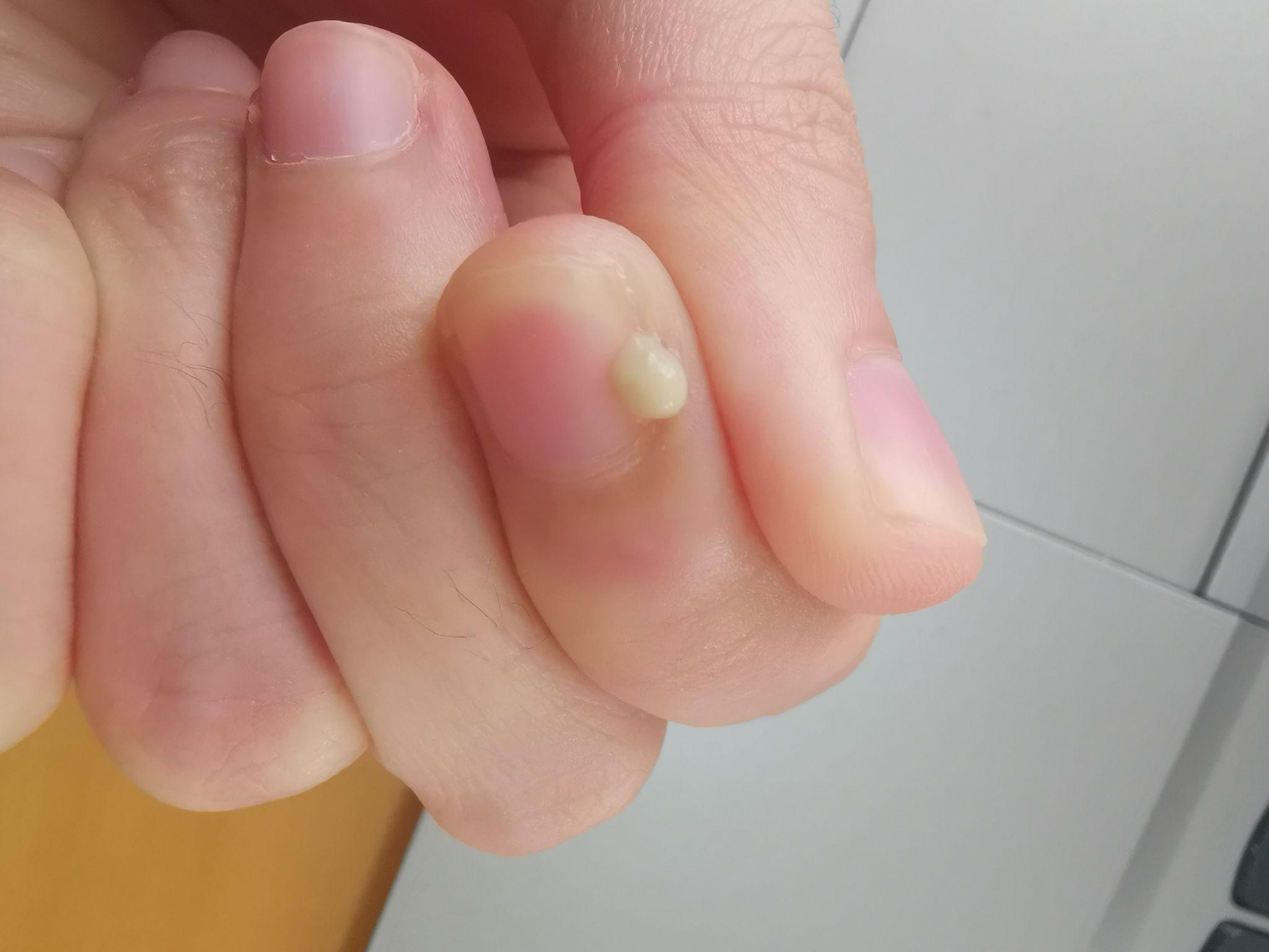 手指处总是长倒刺,能拔吗? - 知乎