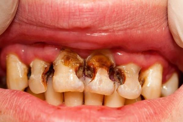 牙齿常见病症之—龋齿