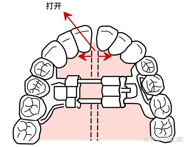 昆明正畸科普:什么是扩弓矫正牙齿 - 知乎