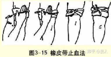 科学的止血方法和注意事项 - 知乎
