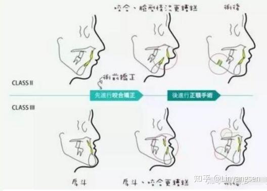 做正颌手术什么年龄最合适? - 知乎