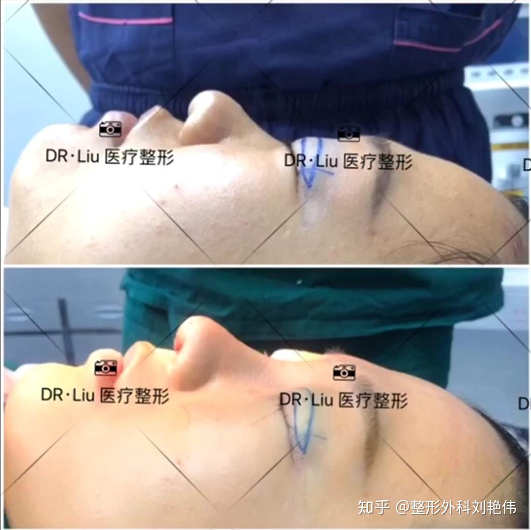 延长鼻小柱和支撑鼻梁的材料,一骨多用