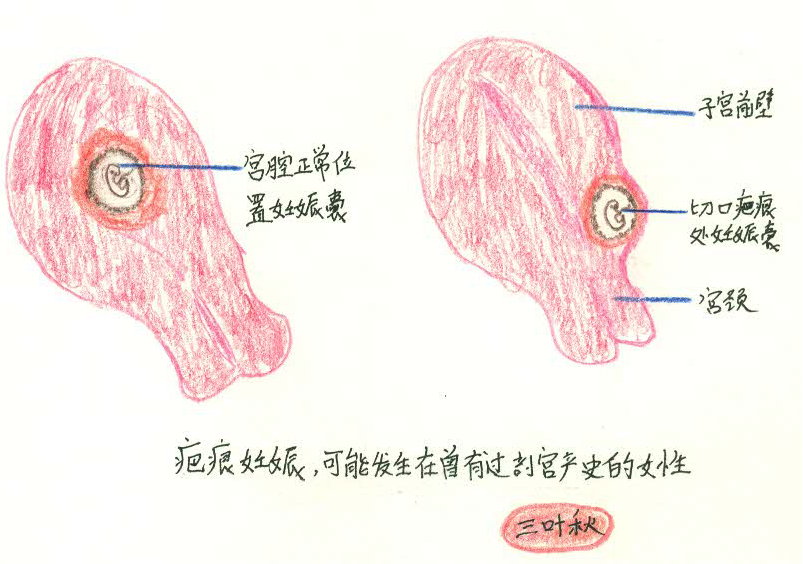 妊娠示意图图片