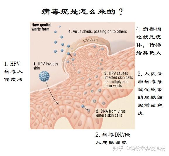 疣是怎么形成的图片