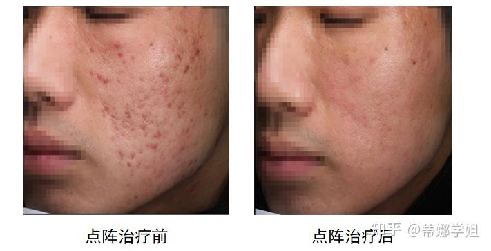 剥脱非剥脱怎么选?点阵激光前必看!