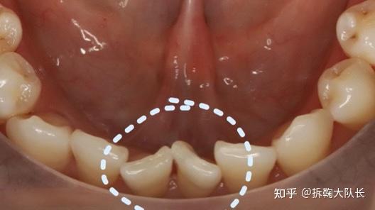 門牙磨損很嚴重,如果看不清我可以再發一張側面側面圖對刃非常明顯