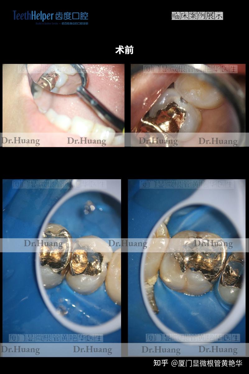 你看得出這是一顆修復過的牙齒嗎全瓷嵌體二次修復一例