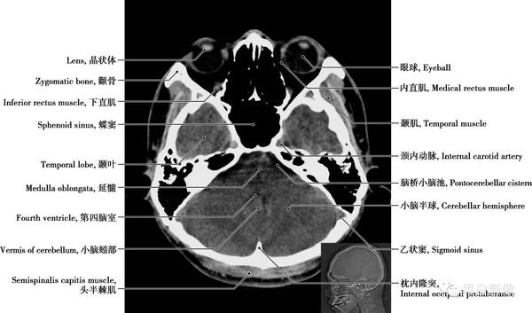 详细标注版!颅脑CT正常解剖图谱 - 知乎