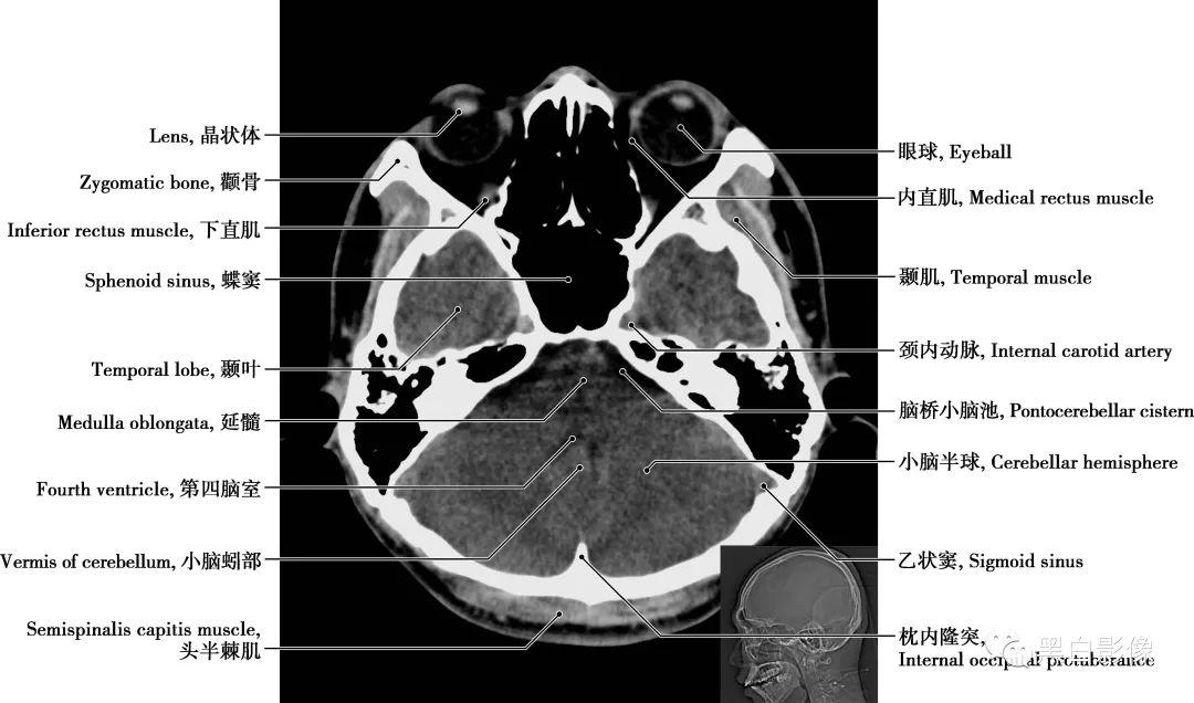 颅骨盲孔图片