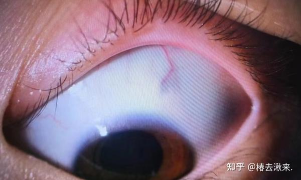 睑板腺堵塞及处理 - 知乎