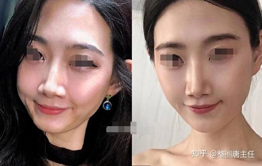 二:少女针和玻尿酸有什么不同?