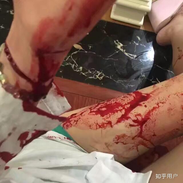 为什么割腕会死人而断臂的人却能活着