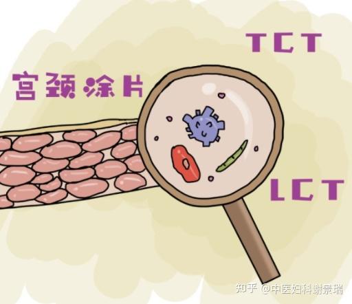 宮頸癌篩查要做哪幾項檢查早發現早治療