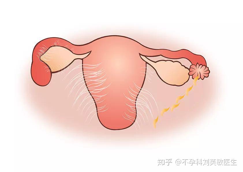 出血性输卵管炎一般由化脓菌引起,病变以黏膜炎症为主,可有输卵管等