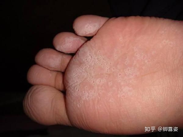 脚露姿 脚气怎么治才能除根 送你治脚气三步曲 知乎