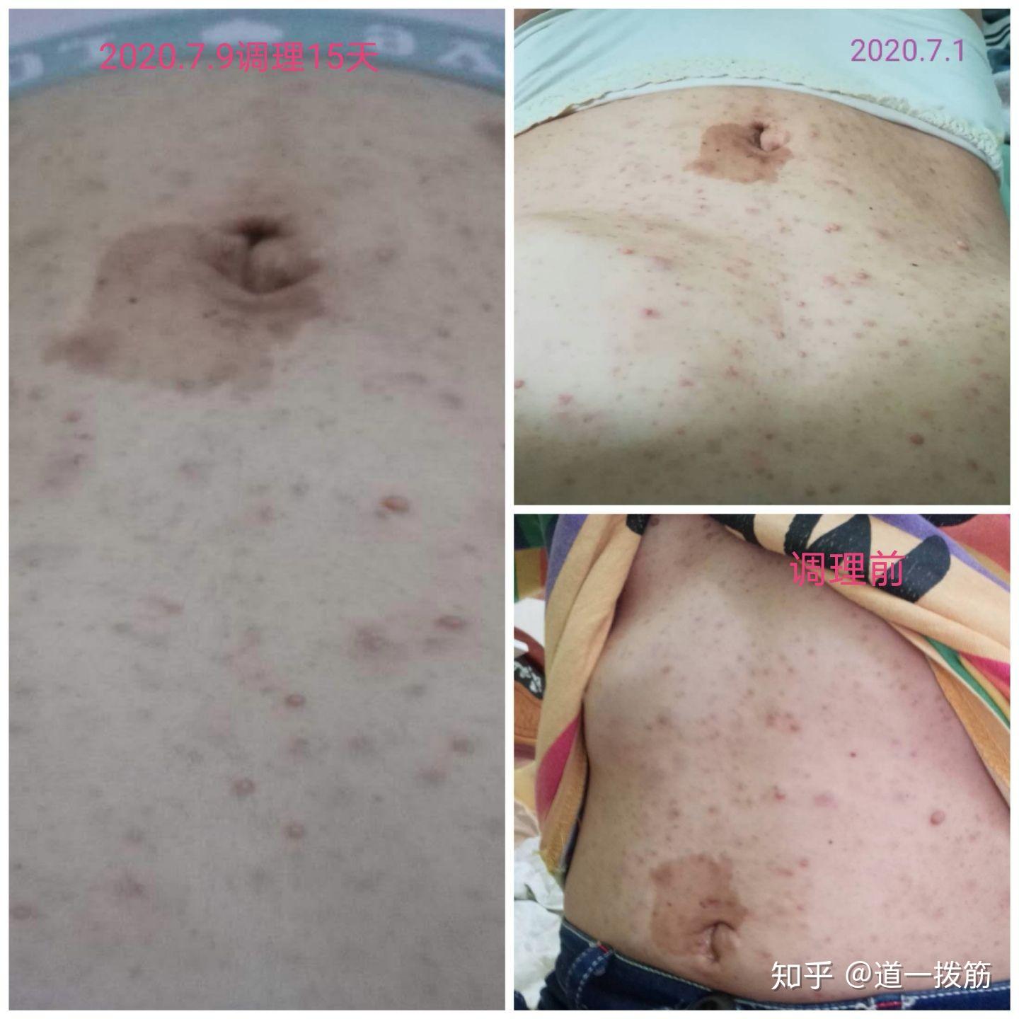 神经纤维瘤调理15天邵女士