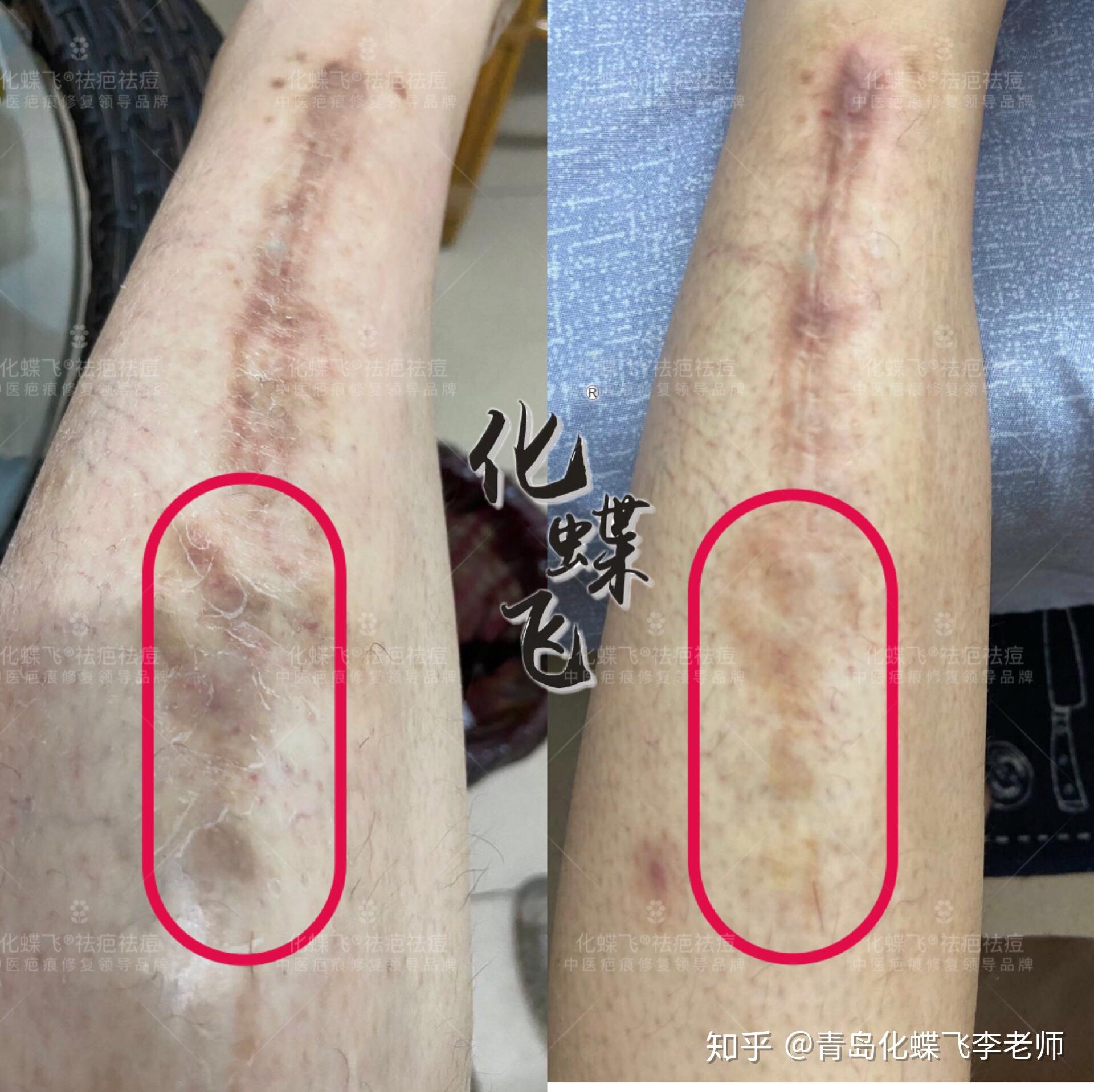 骨折手术疤痕怎么修复
