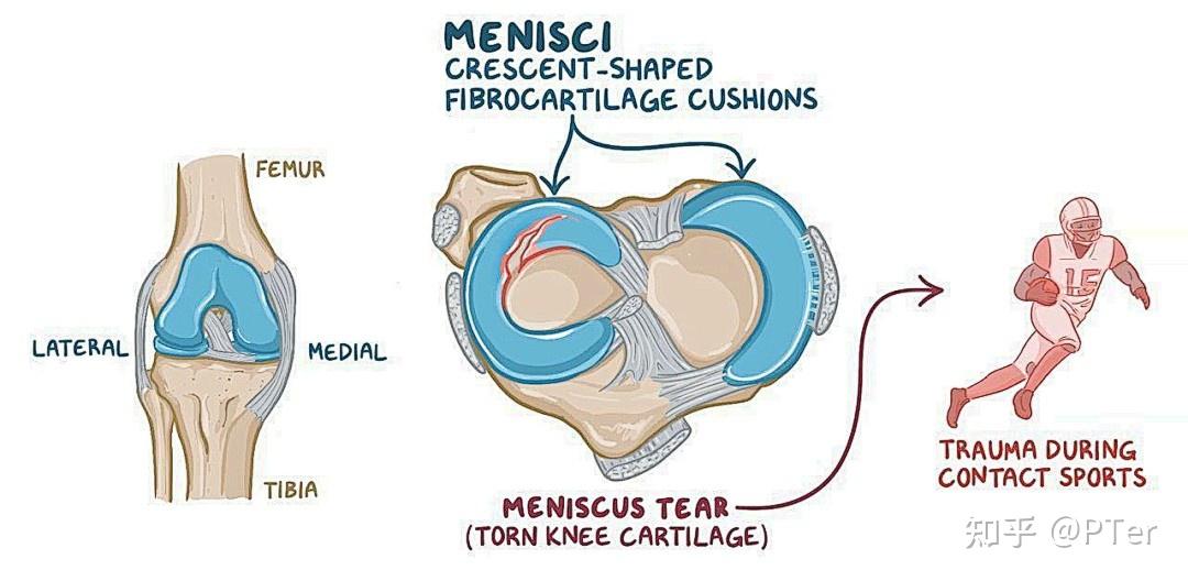 膝關節半月板的結構功能和損傷機制