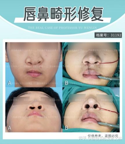 【案例分析】难堪的青春期要结束了:终于等到了唇鼻畸形修复的年龄! - 知乎