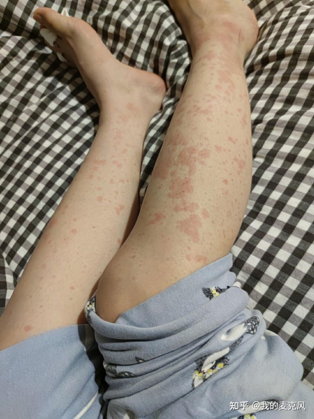 湿疹会传染吗? 