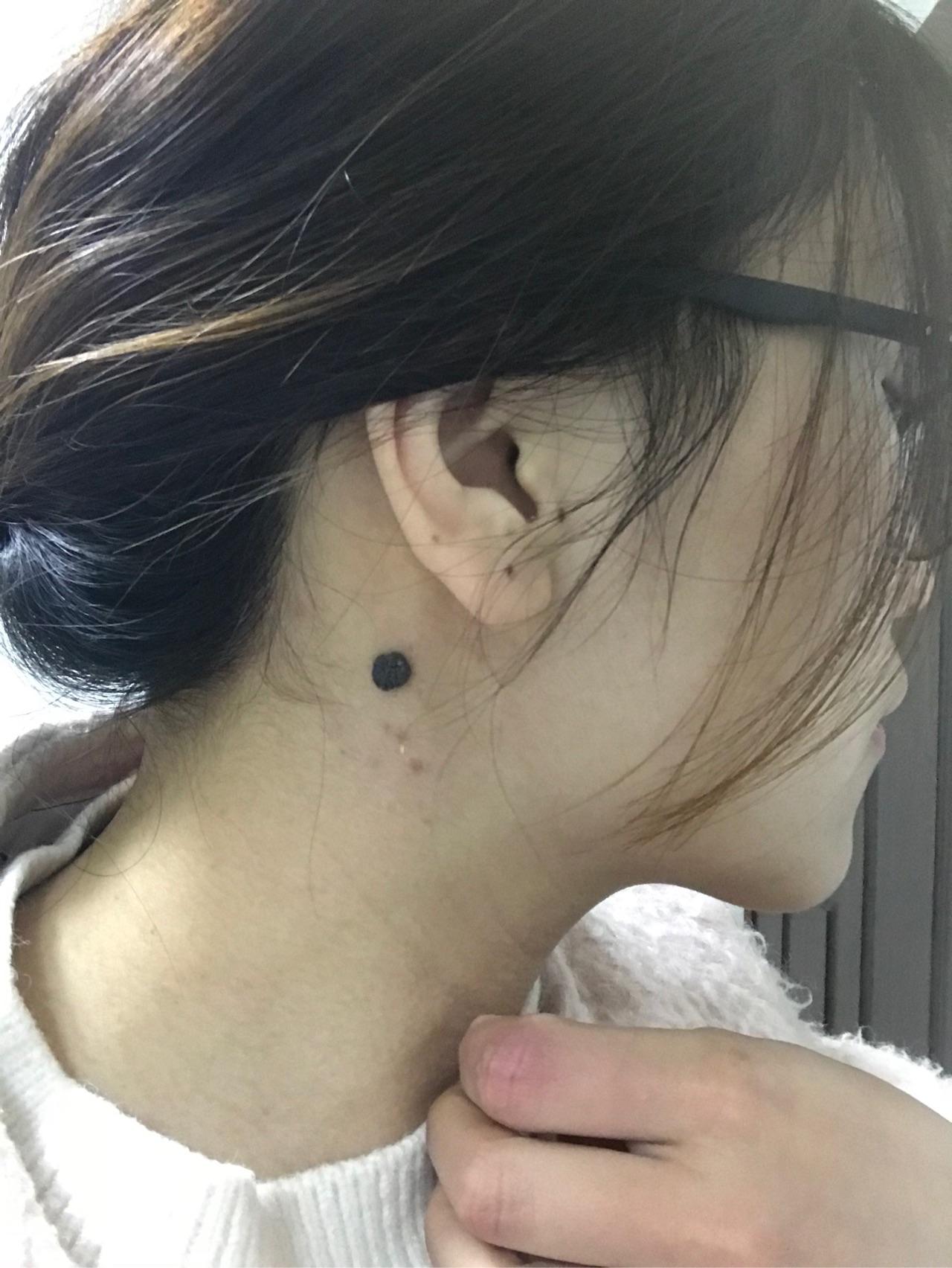 手术切痣是一种怎样的体验?