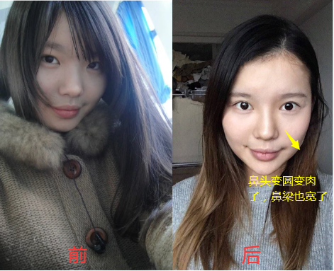 整形老司机告诉你玻尿酸隆鼻后鼻子会变宽是真的