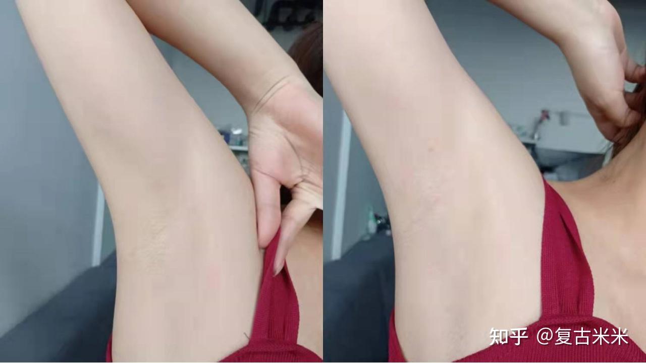 刮毛刀会越刮毛越多脱毛仪真的有用冰点脱毛究竟是不是智商税