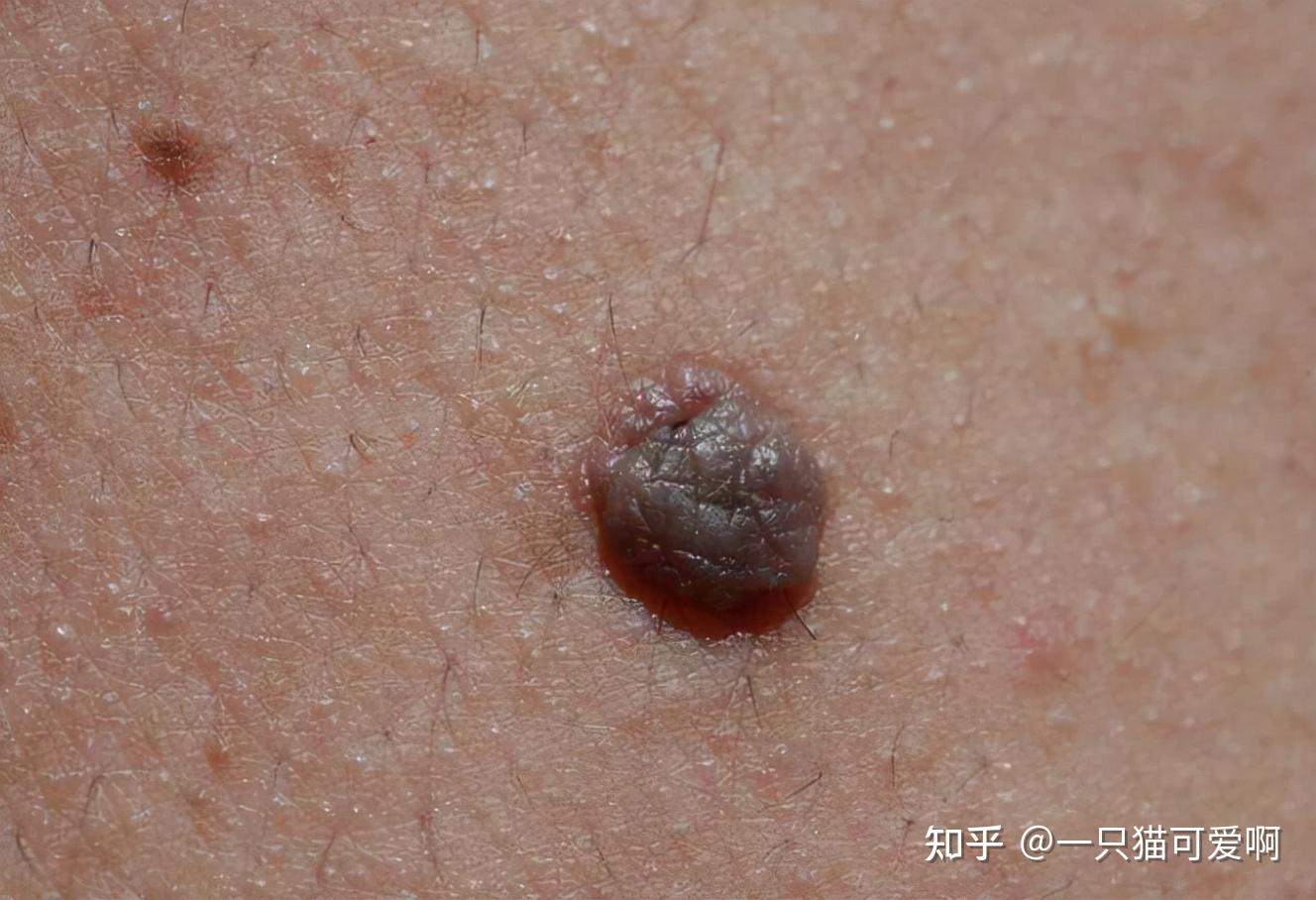 板形似鸡眼但实际上是hpv病毒感染所引起,形似黄豆或者更大点的丘疹