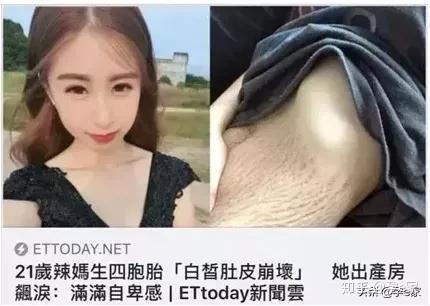 当心 妊娠纹也挑人 这6类妈妈最容易长纹 知乎