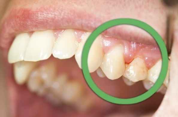 但在临床上,我还是经常看到患者:牙齿表面清洁得非常到位,但是牙龈