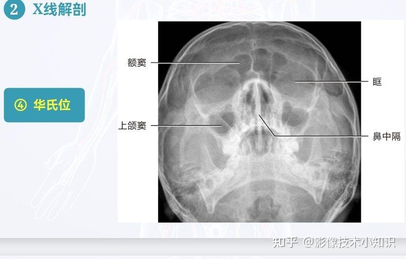 鼻旁窦柯氏位图片图片