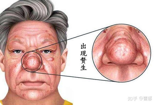 酒糟鼻快速解决方法每天1次1周消除