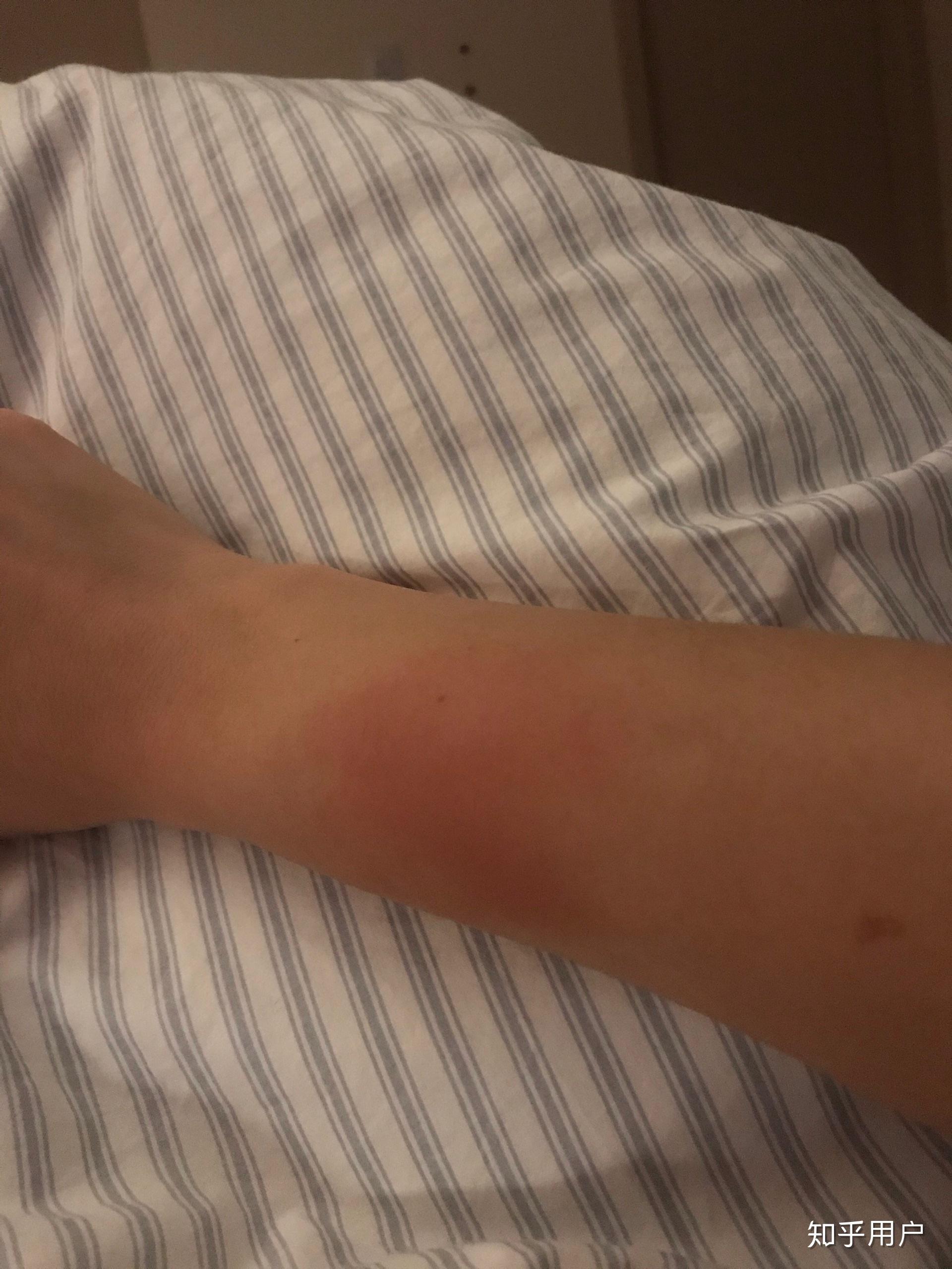 为什么手臂莫名疼痛红肿.特别是旋转时,疼痛难忍? - 知乎