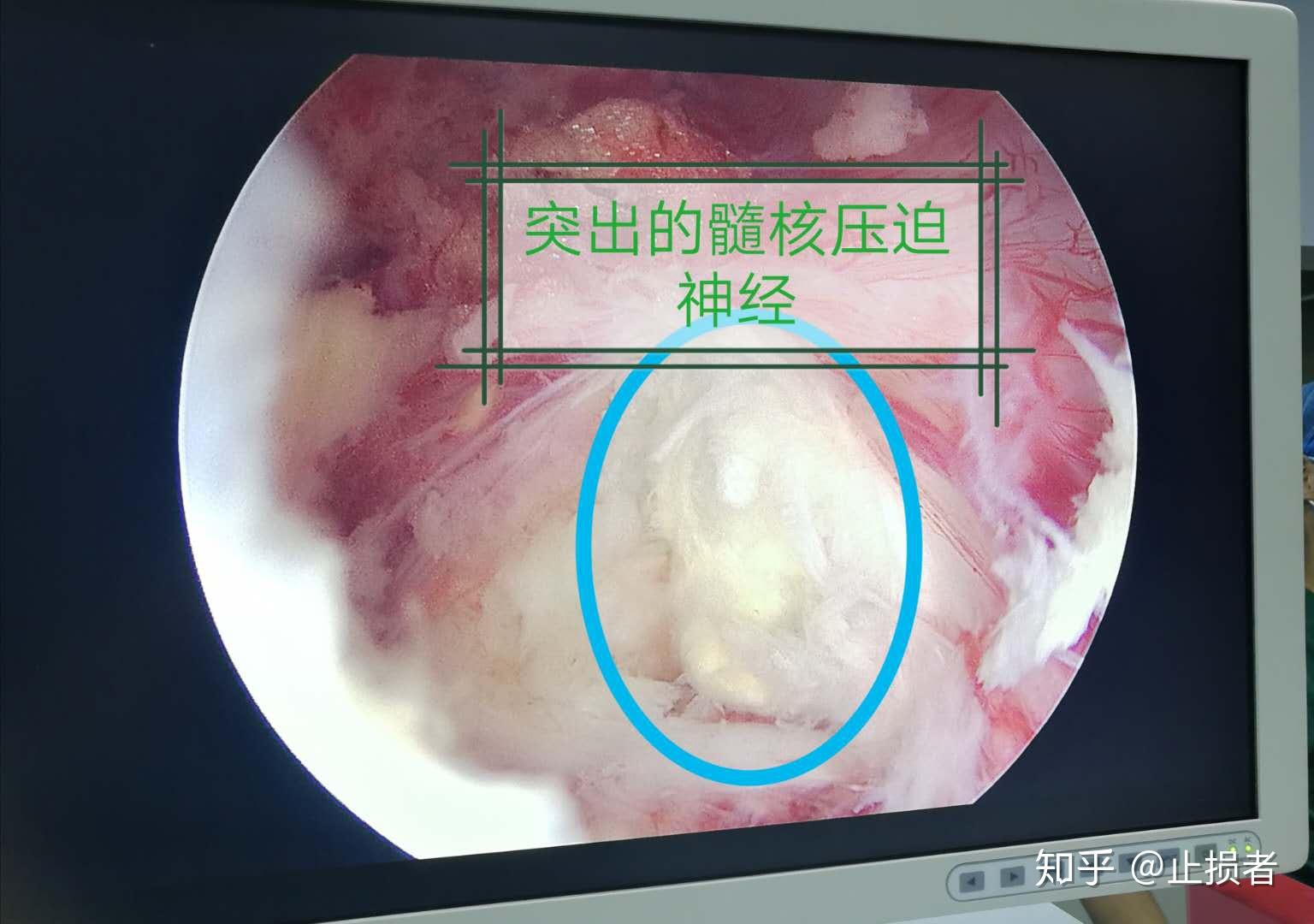 突出的髓核壓迫神經摘除突出髓核,環節壓迫症狀釘棒內固定系統切口