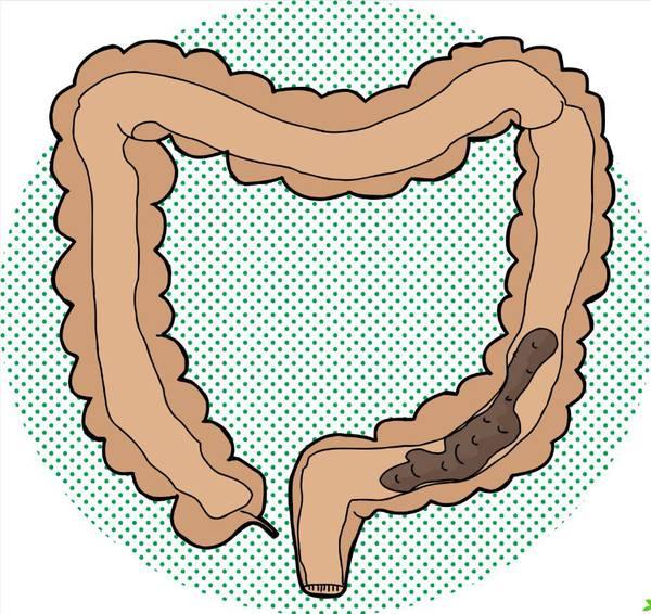 既然宿便是个伪科学,那便秘患者身体内的粪便到到哪里去了呢?