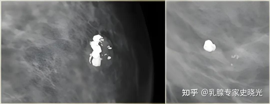 乳腺结节钙化灶,这 3 个危险信号,千万别忽视 - 知乎