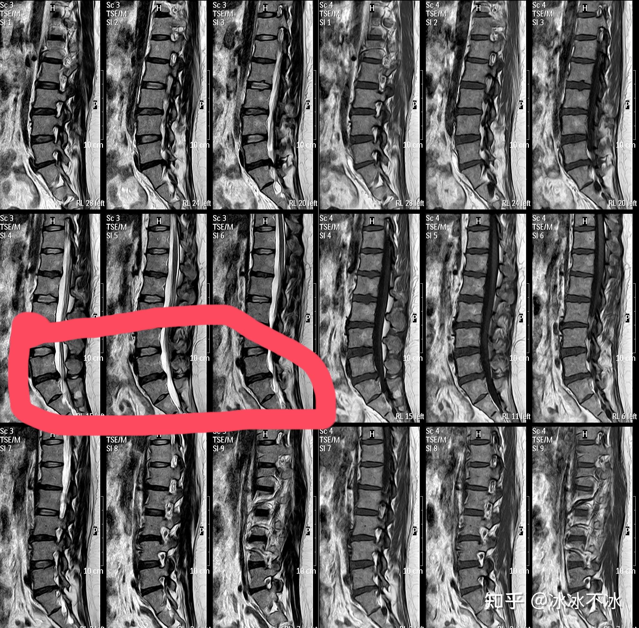 腰间盘突出磁共振图片图片
